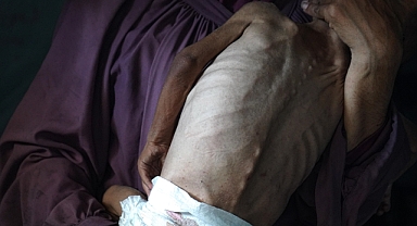 İsrail'in kıtlığı dayattığı Gazze'de son 24 saatte 1'i çocuk 6 kişi daha açlıktan hayatını kaybetti