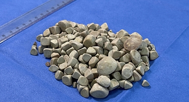 Vücudundan 287 tane taş çıkarıldı, doktorlar bile şok oldu: 