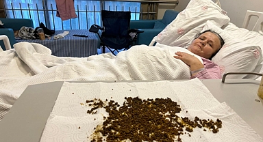 Hastadan çıkan taşları sayamadılar