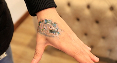 Dövme sildirmek isterken kabusu yaşadı, elindeki dokular öldü