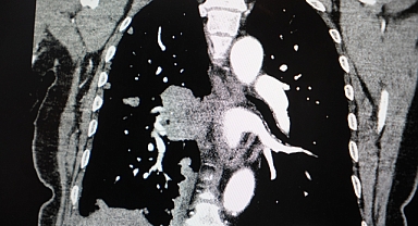 Profesörden korkutan sigara açıklaması: